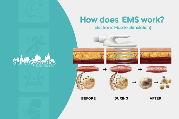 EMS treatment for post pregnancy weight loss treatment Inverness