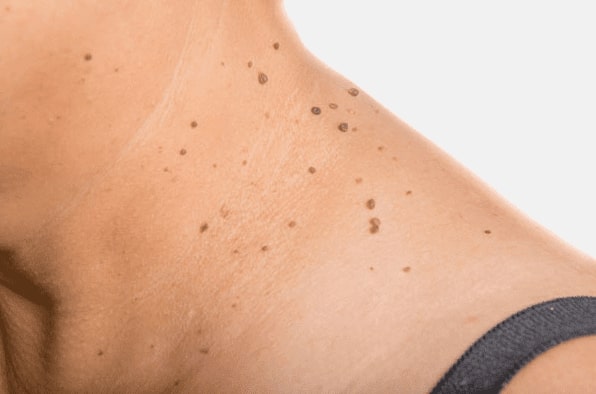 Are you looking for easy skin tag removal Inverness - then contact Spire today!