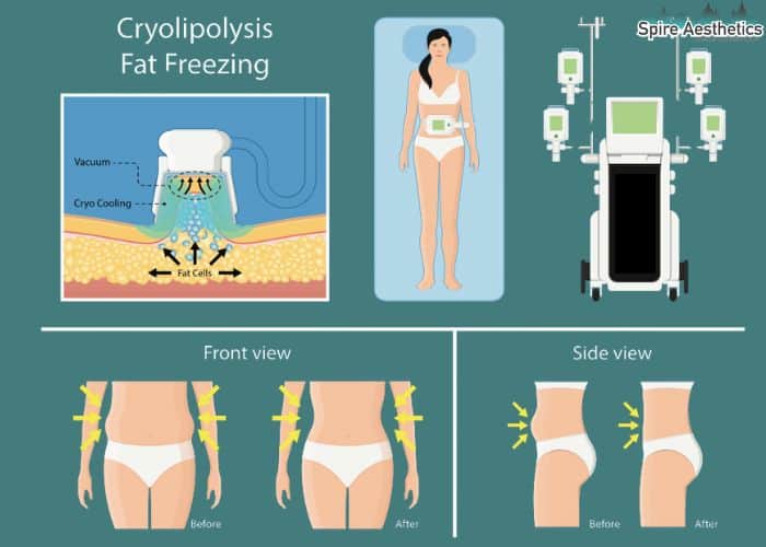 Image of diet and fat freezing combined for best results for Spire Aesthetics Inverness