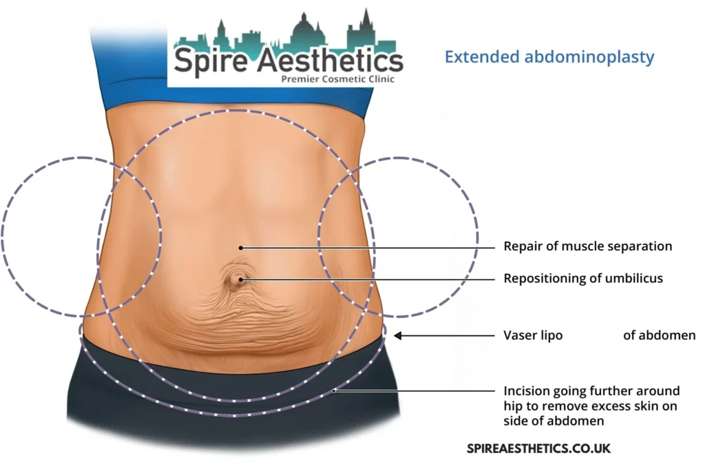 Understanding Loose Skin After Gastric Band Inverness Surgery and HIFU Treatment