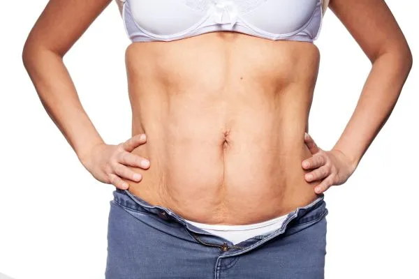 sagging skin on woman's stomach after weight loss injections Inverness
