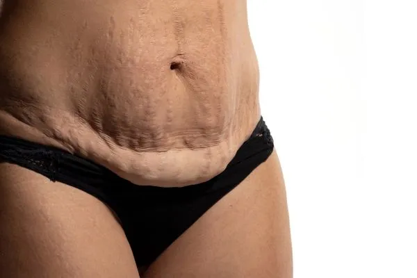 Image of womans stomach after weight loss injections Inverness showing saggy skin